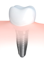 Dental Implant