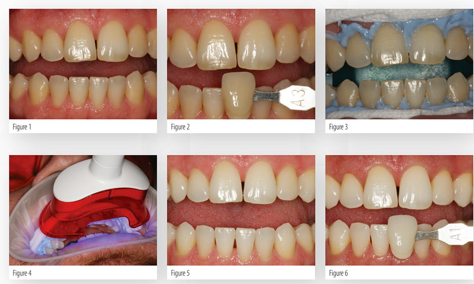 Whitening Case Study